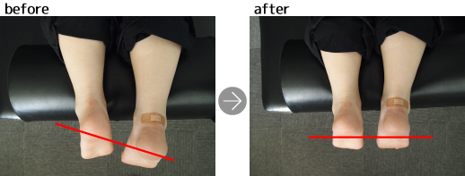 [写真]施術前後比較～脚の位置～